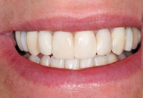 The image shows a close-up view of a person s smile with straight white teeth, displaying a healthy oral condition.
