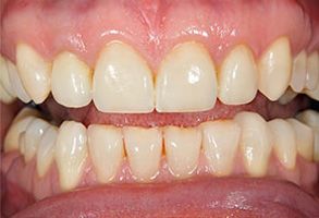 The image shows a close-up of a person s teeth with some discoloration, particularly noticeable on the front teeth, and there appears to be an area of decay or damage near the top front tooth.