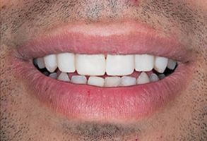 The image shows a close-up of a person s mouth with teeth showing, and the individual appears to be smiling or laughing.