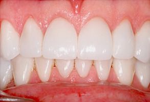 The image features a close-up view of a person s teeth with a focus on the lower front teeth, showcasing their whiteness and cleanliness.