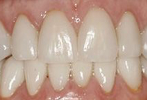The image displays a close-up view of a person s teeth with a focus on their lower front teeth, which appear to be yellowed and possibly stained, with some areas showing discoloration.